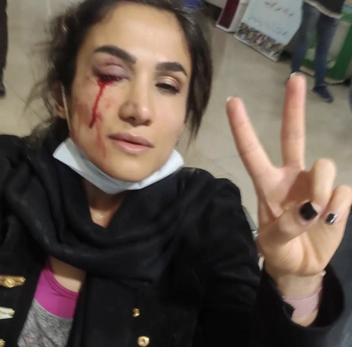 They blinded her gaze nevertheless couldn’t rupture her spirit. Iranian girl shot in gaze by Islamic Republic safety forces.