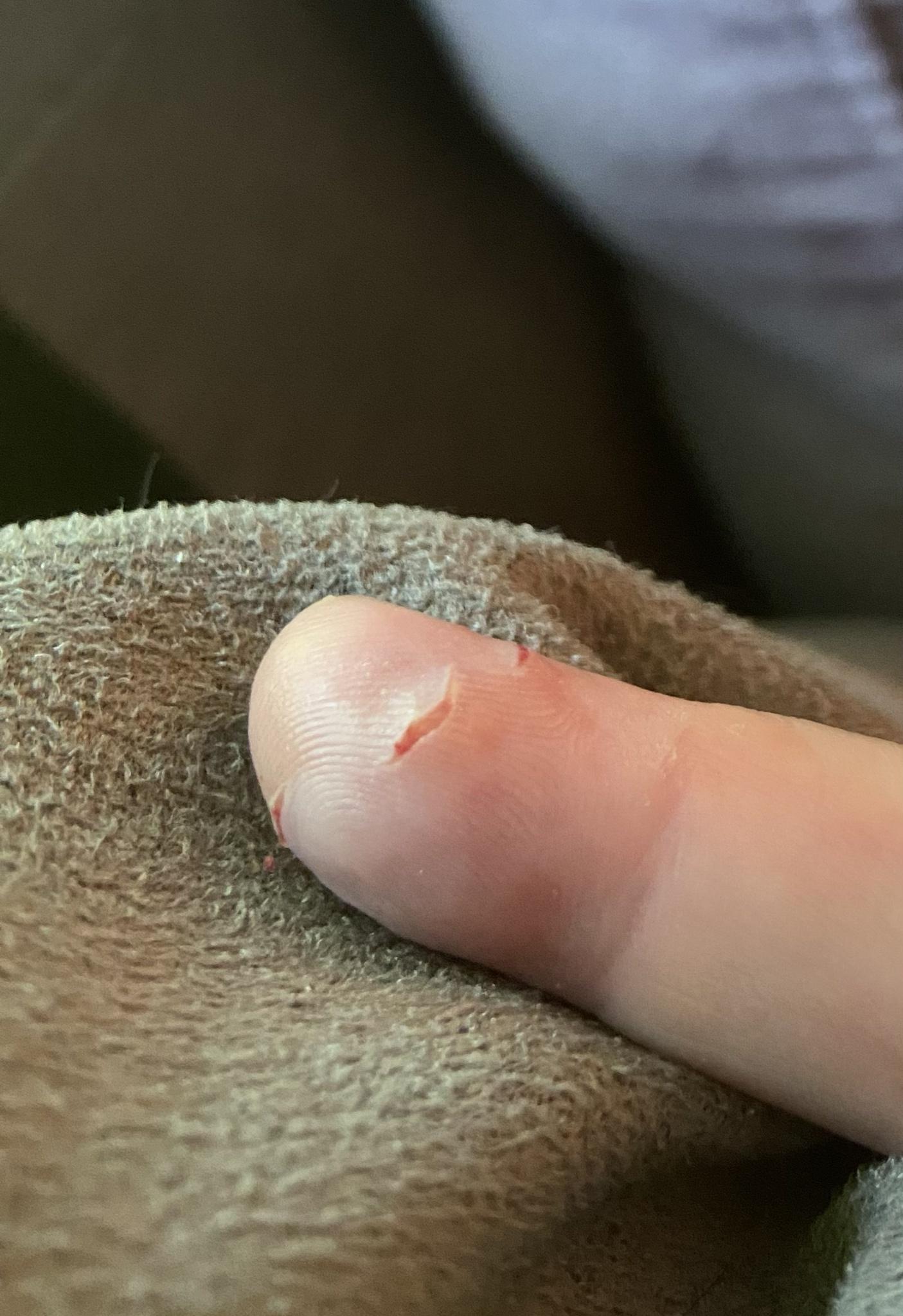 Swollen cat bites on finger